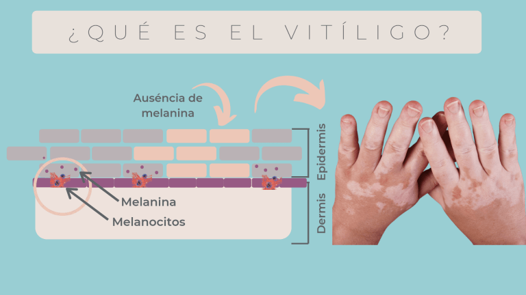 Vitíligo: La Causa Del Blanqueamiento De Michael Jackson